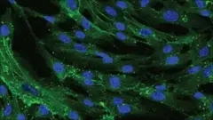 Significant stem cell trial for Multiple Sclerosis patients