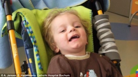 Brain damage and paralysis reversed by toddler’s own cord blood stem cells