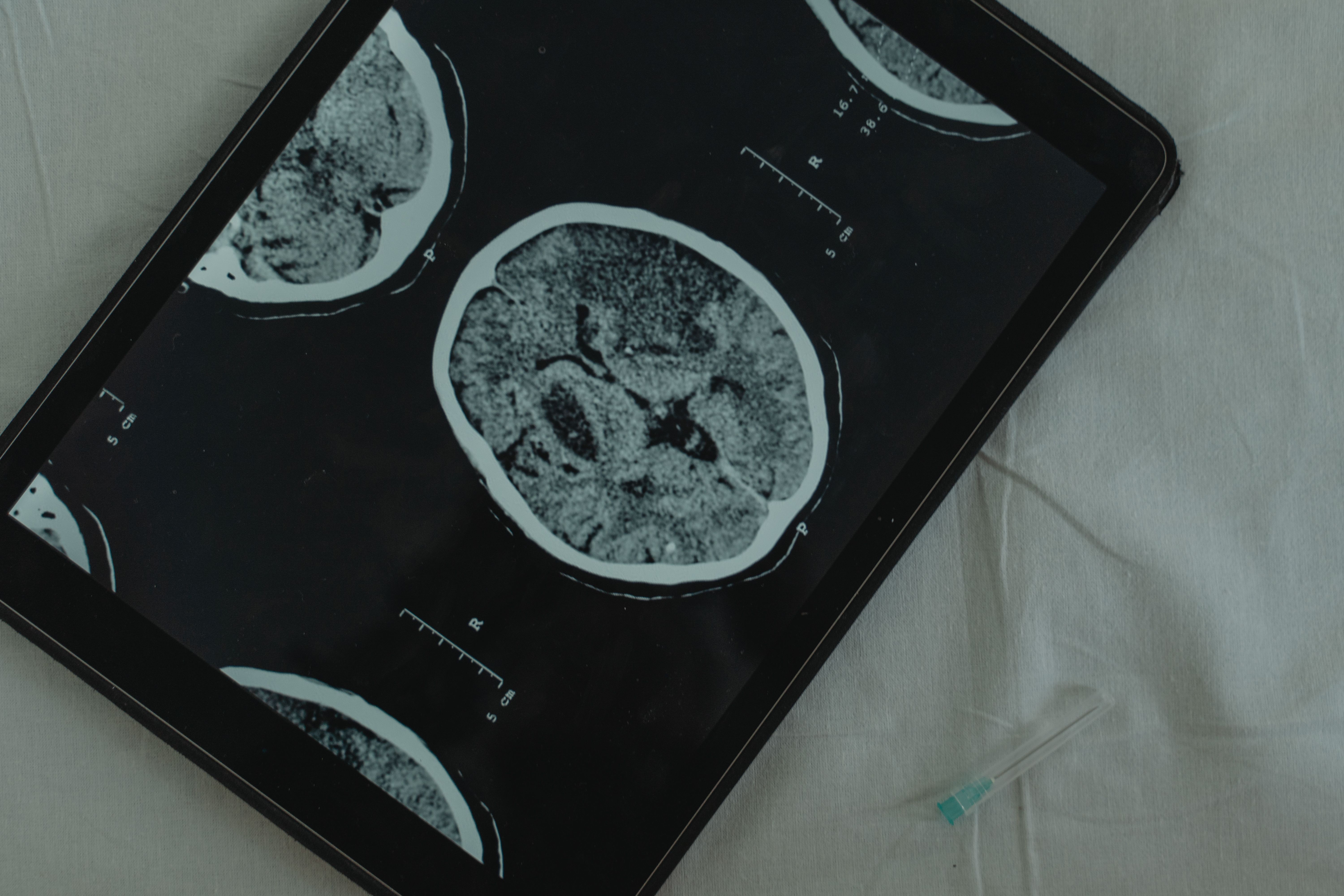 Stem Cell Stroke Trial Reports Encouraging Early Safety Results